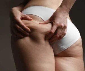 Салон массажа Insay в Харькове Антицеллюлитный массаж